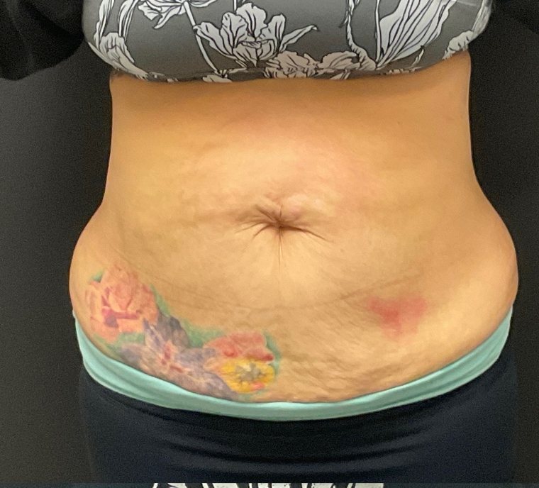 The same abdomen in December 2025 after a course of EmSculpt NEO, showing a flatter contour and improved definition