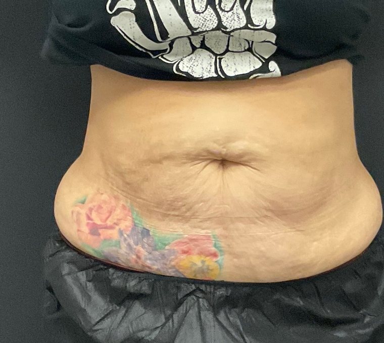 Abdomen in October 2025 before EmSculpt NEO&reg; treatment