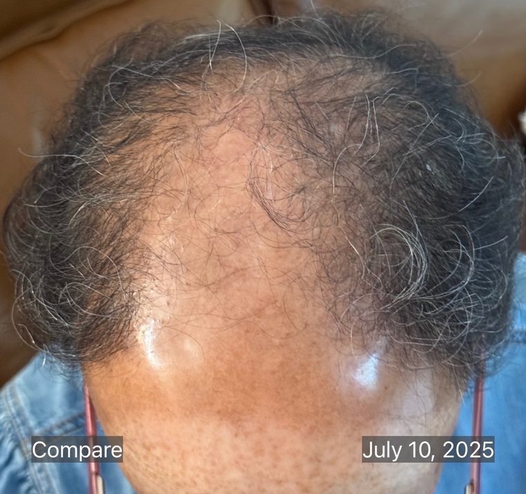 The same scalp after a course of microneedling, showing increased density