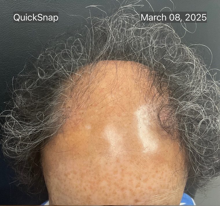 Scalp before microneedling treatment for hair loss, showing thinning at the crown