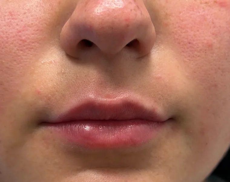 The same lips at rest after dermal filler, showing restored volume
