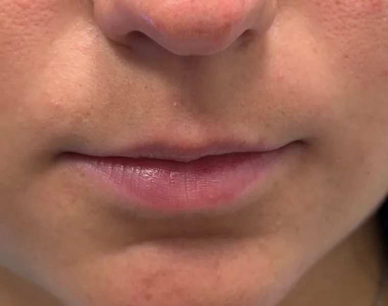 Lips at rest before dermal filler treatment