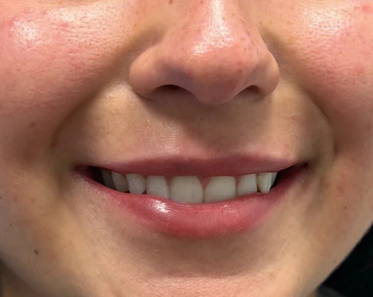 The same smile after dermal filler treatment