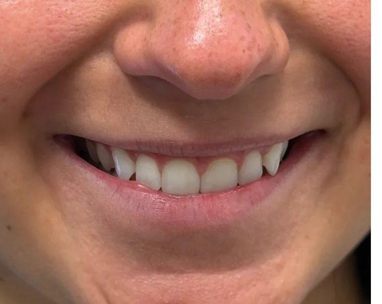Smile before dermal filler treatment