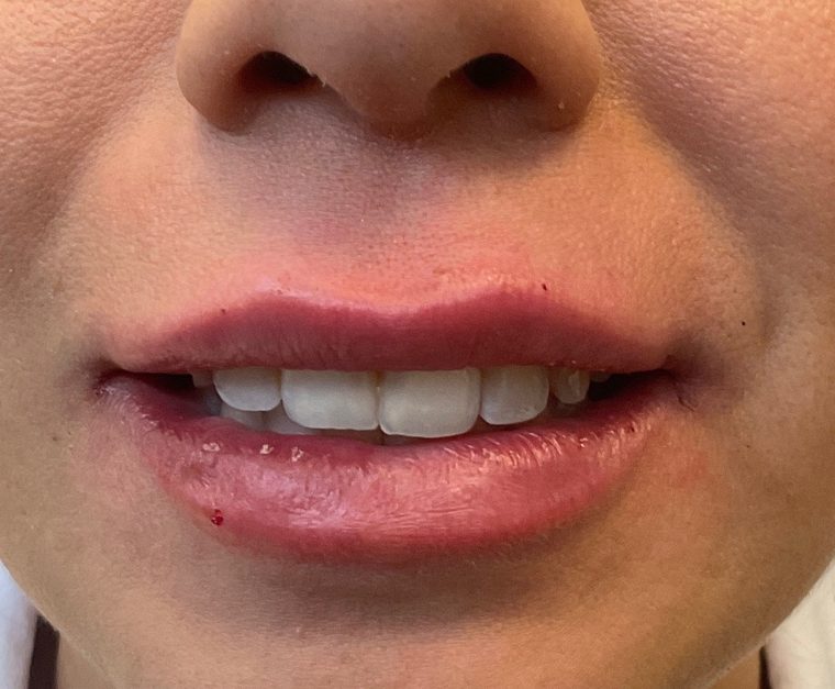 The same lips after dermal filler, showing balanced volume and a defined border