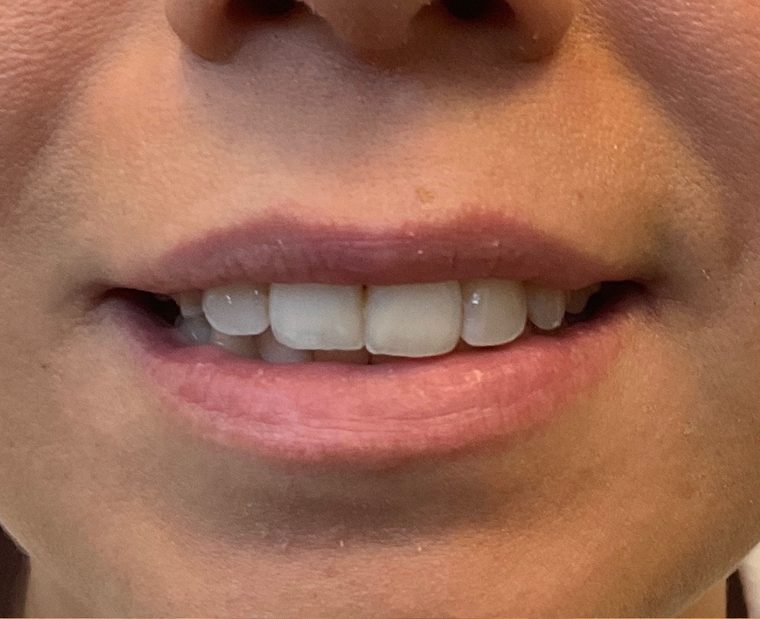 Lips before dermal filler treatment, showing a thin upper lip