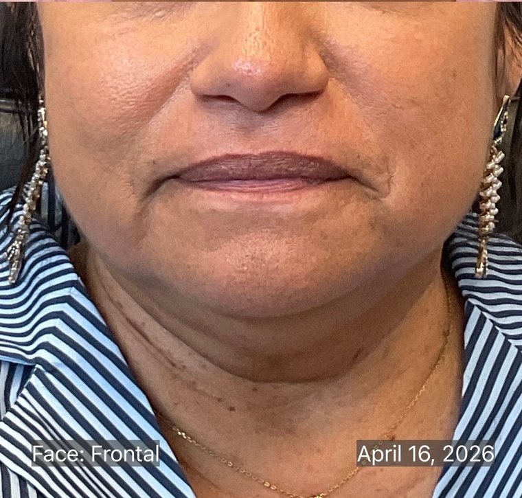 The same jawline in April 2026 after RF microneedling, showing a firmer contour and smoother skin texture