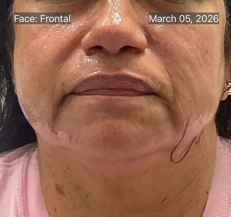 Lower face and jawline in March 2026 before RF microneedling, showing softening along the jaw and neck