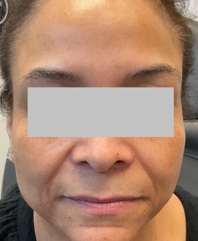 The same forehead in October 2023 after ongoing neuromodulator treatment, with the lines substantially softened and the brow still mobile
