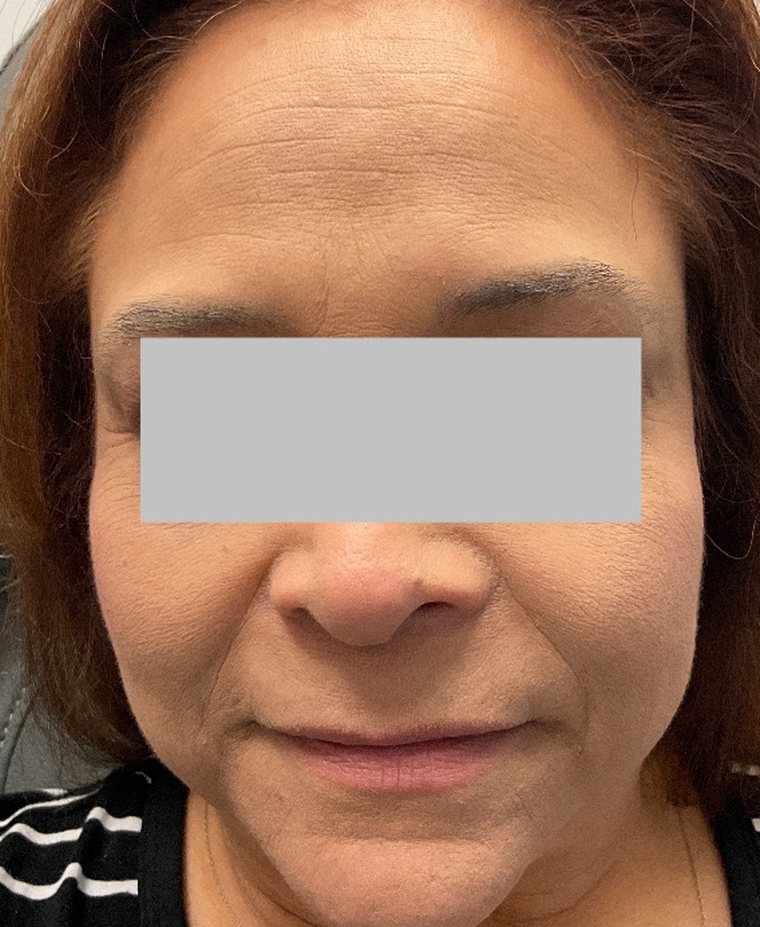 Forehead and brow in March 2022 before neuromodulator treatment, showing horizontal forehead lines at rest