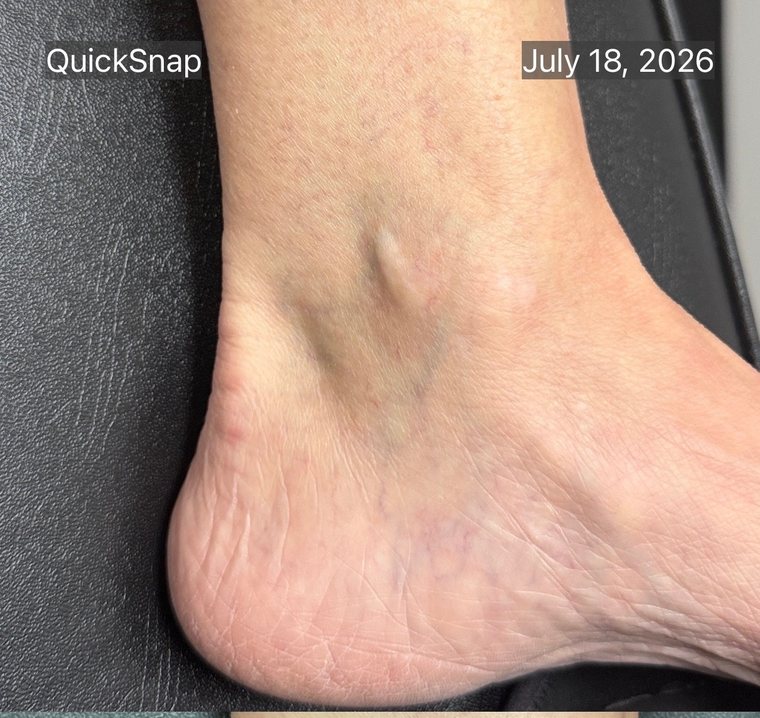 The same ankle in July 2026 after vascular laser, with the spider veins substantially cleared