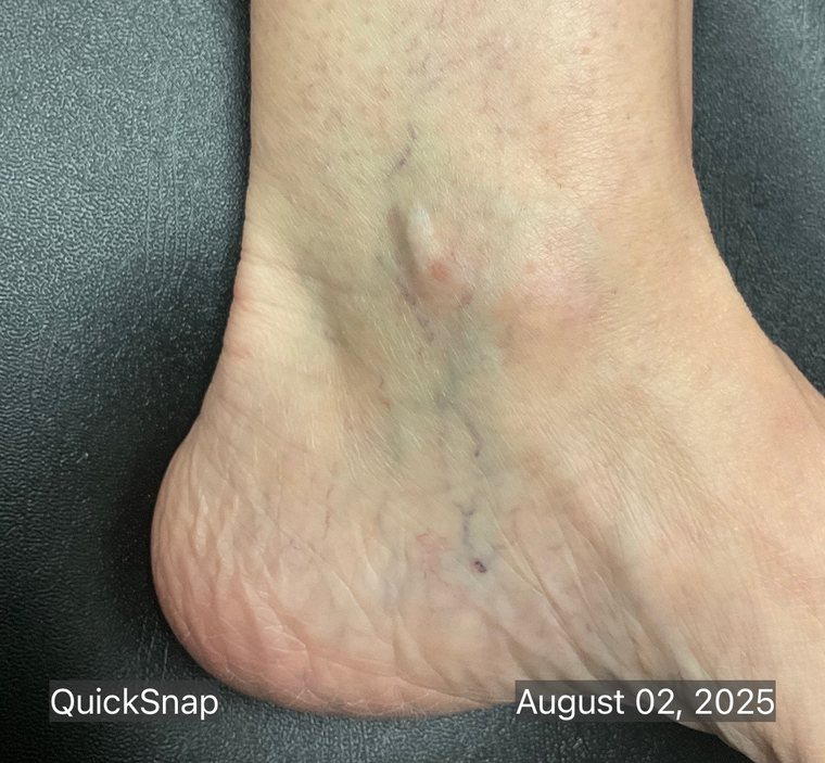 Ankle in August 2025 before vascular laser, showing visible spider veins